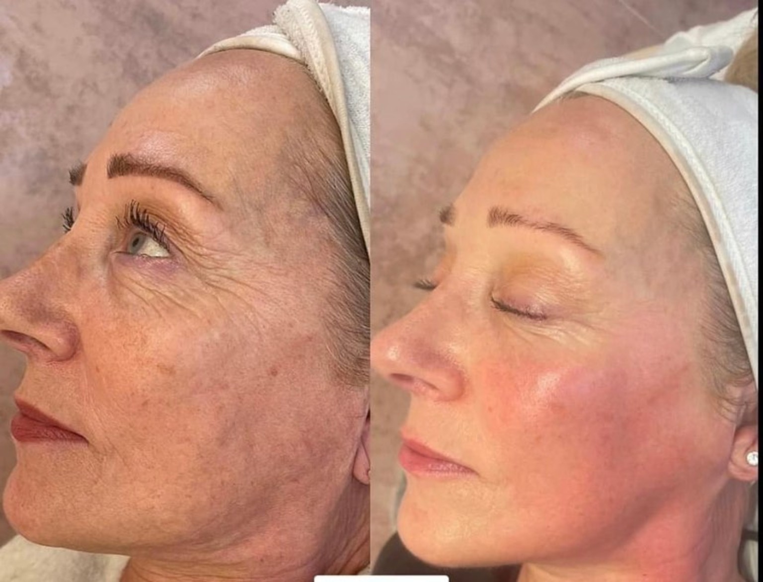 Facial skin treatment before and after comparison