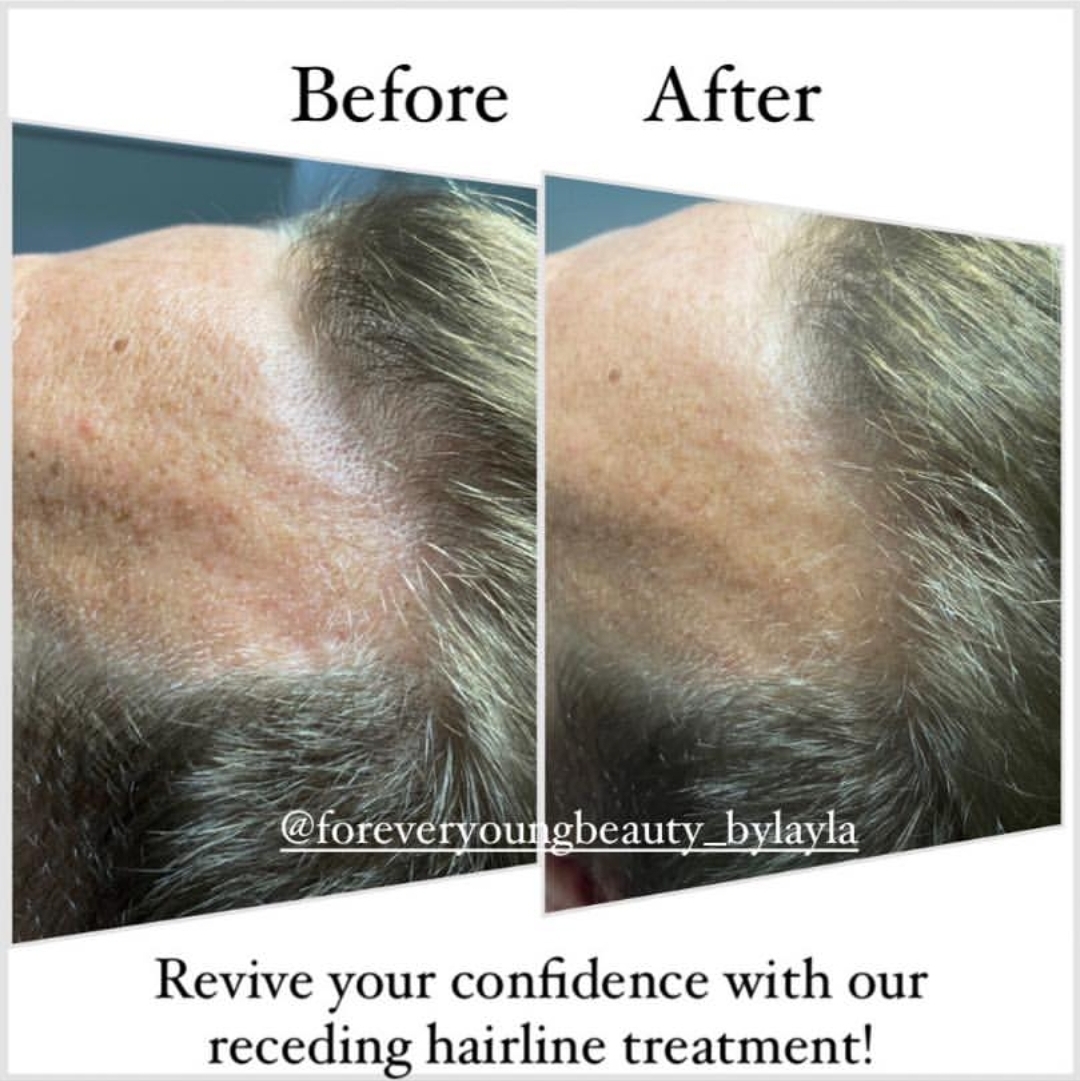 Hairline treatment