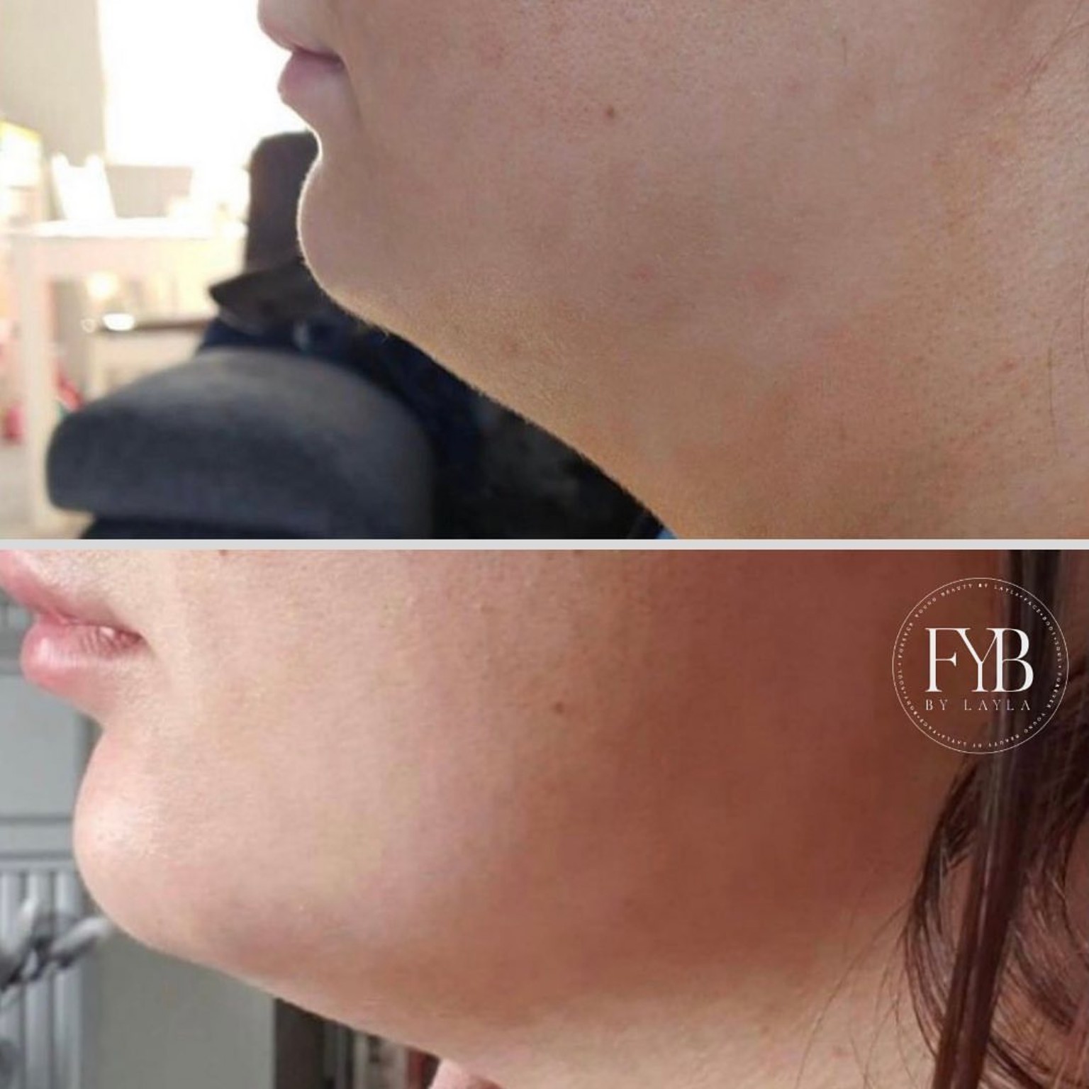 Jawline treatment before and after comparison